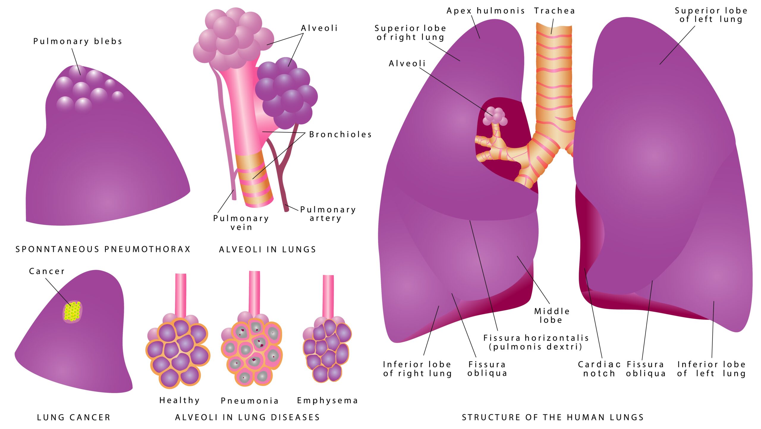 Spontaneous Pneumothorax: Things to Know